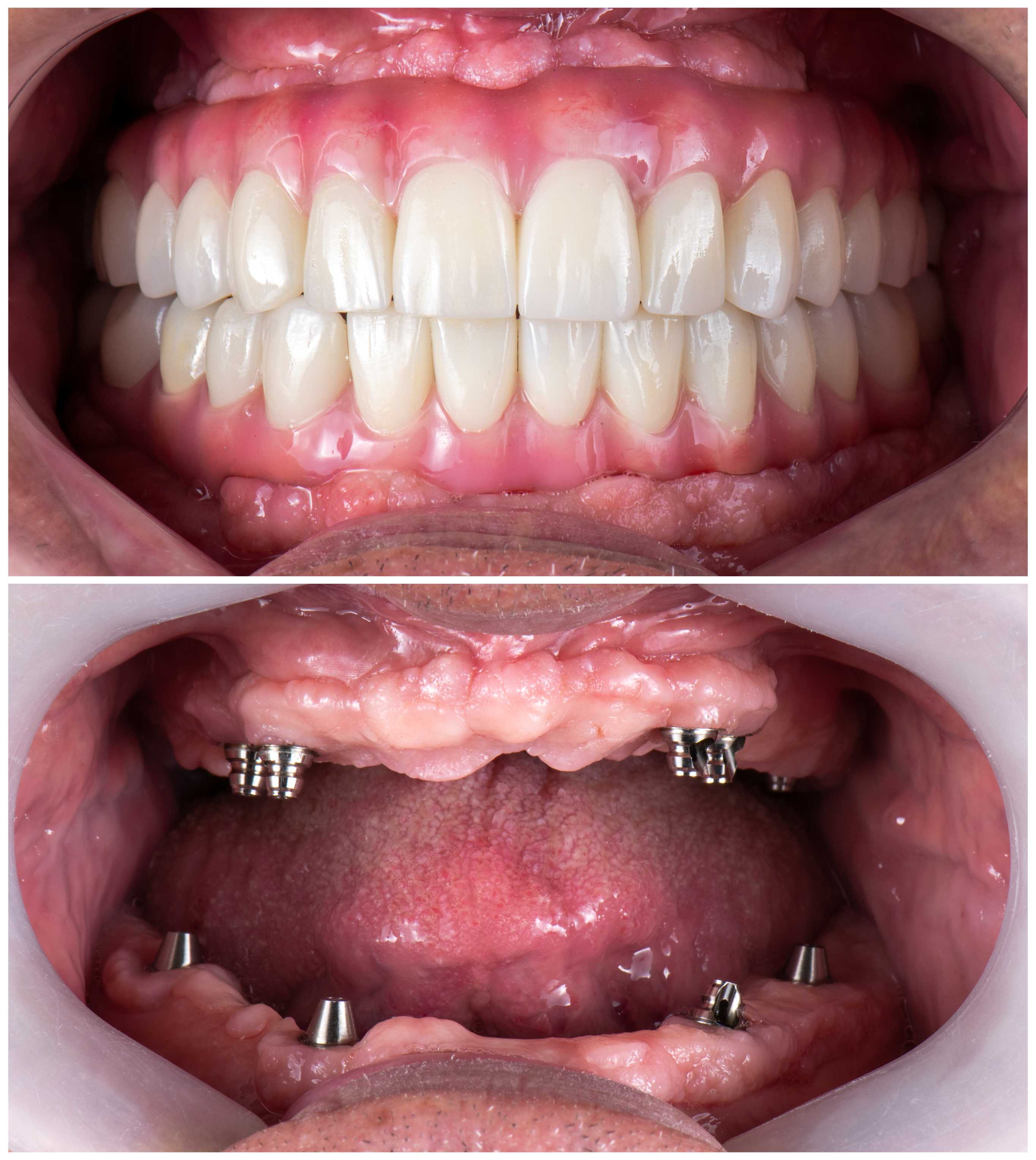 Close-up of a mouth showing upper dental implants with attached prosthetic teeth and lower dental implants without teeth.