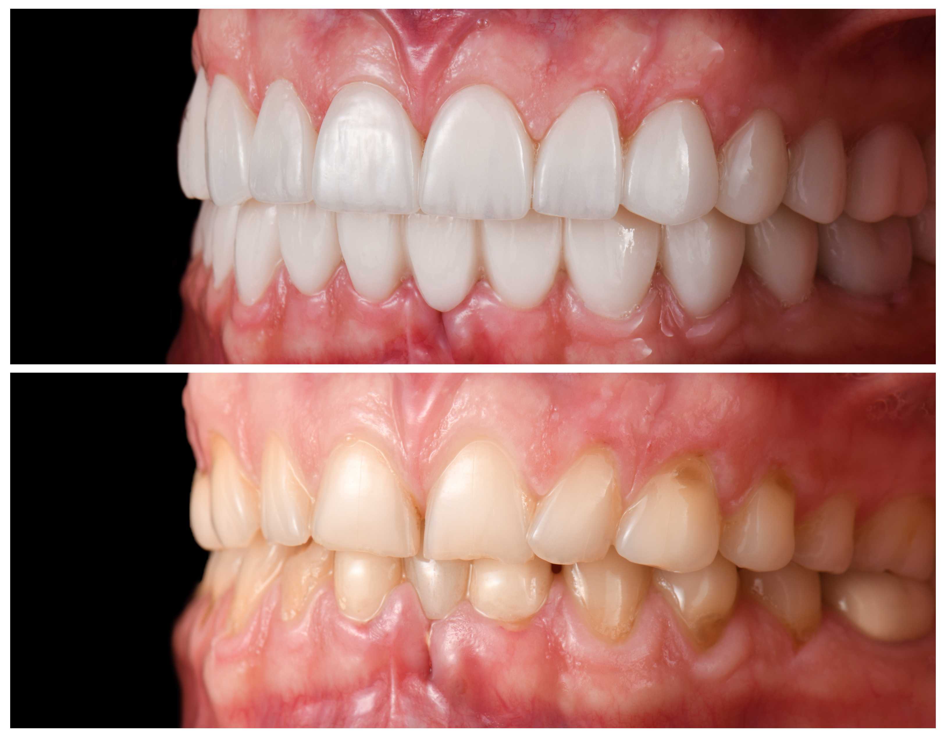 Comparison of upper and lower teeth before and after dental whitening or restoration treatment, showing whiter teeth on top and stained teeth below.