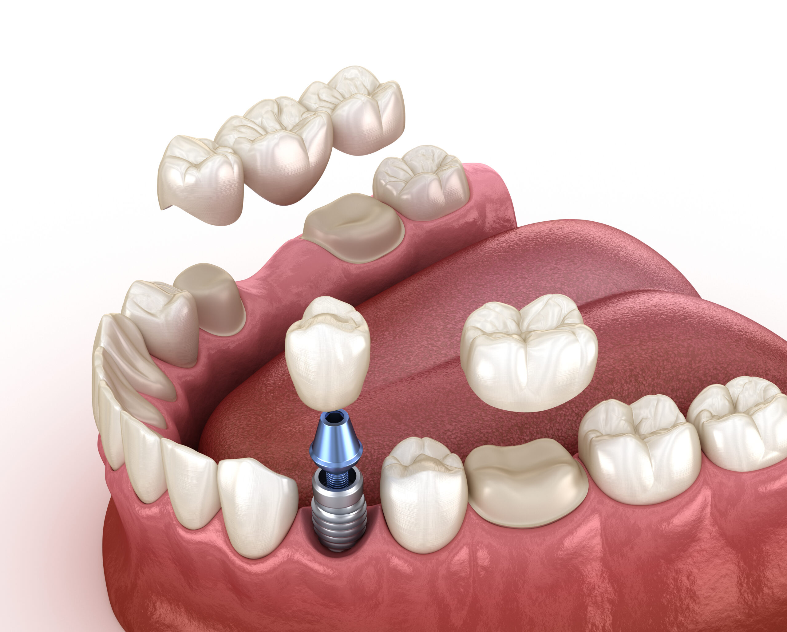 3D illustration of a dental implant with crown being placed in a lower jaw alongside natural teeth and dental bridges.