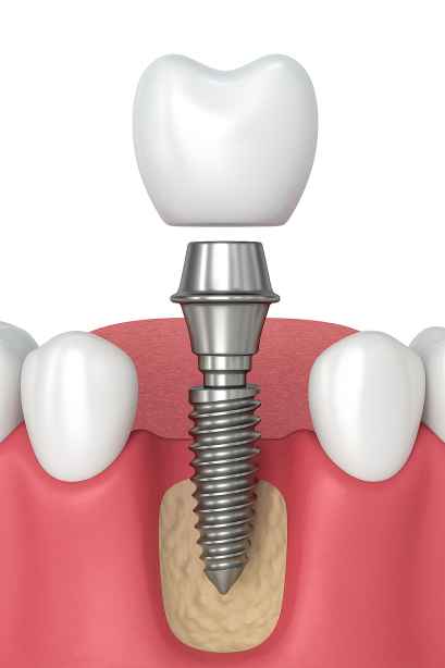3D illustration of a dental implant with a screw anchored in the jawbone and a crown above the gum line between natural teeth.