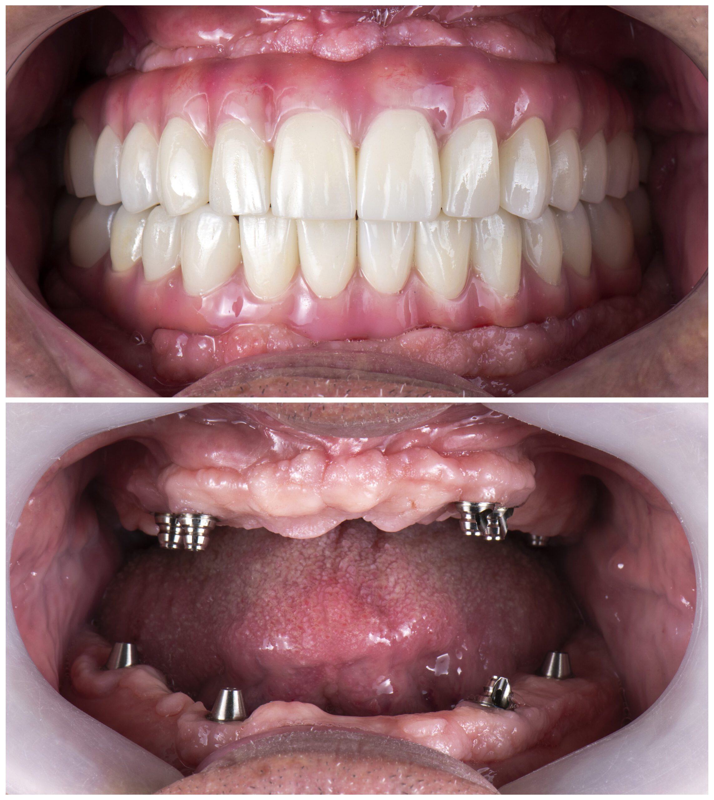 Close-up of upper and lower jaw showing dental implants on lower gums and full set of artificial teeth on upper gums.