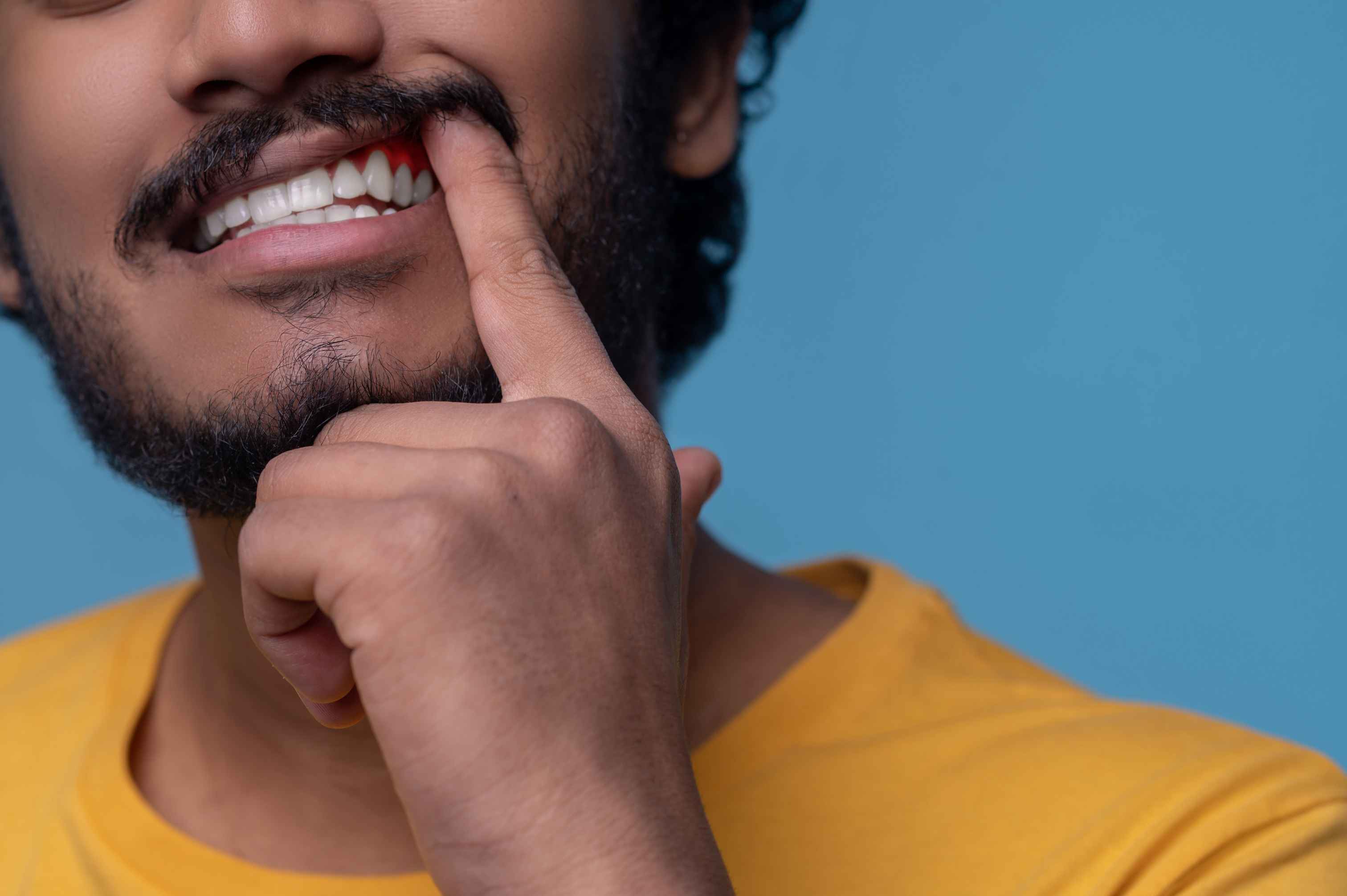 Man in yellow shirt pointing to red, inflamed gums on upper front teeth.