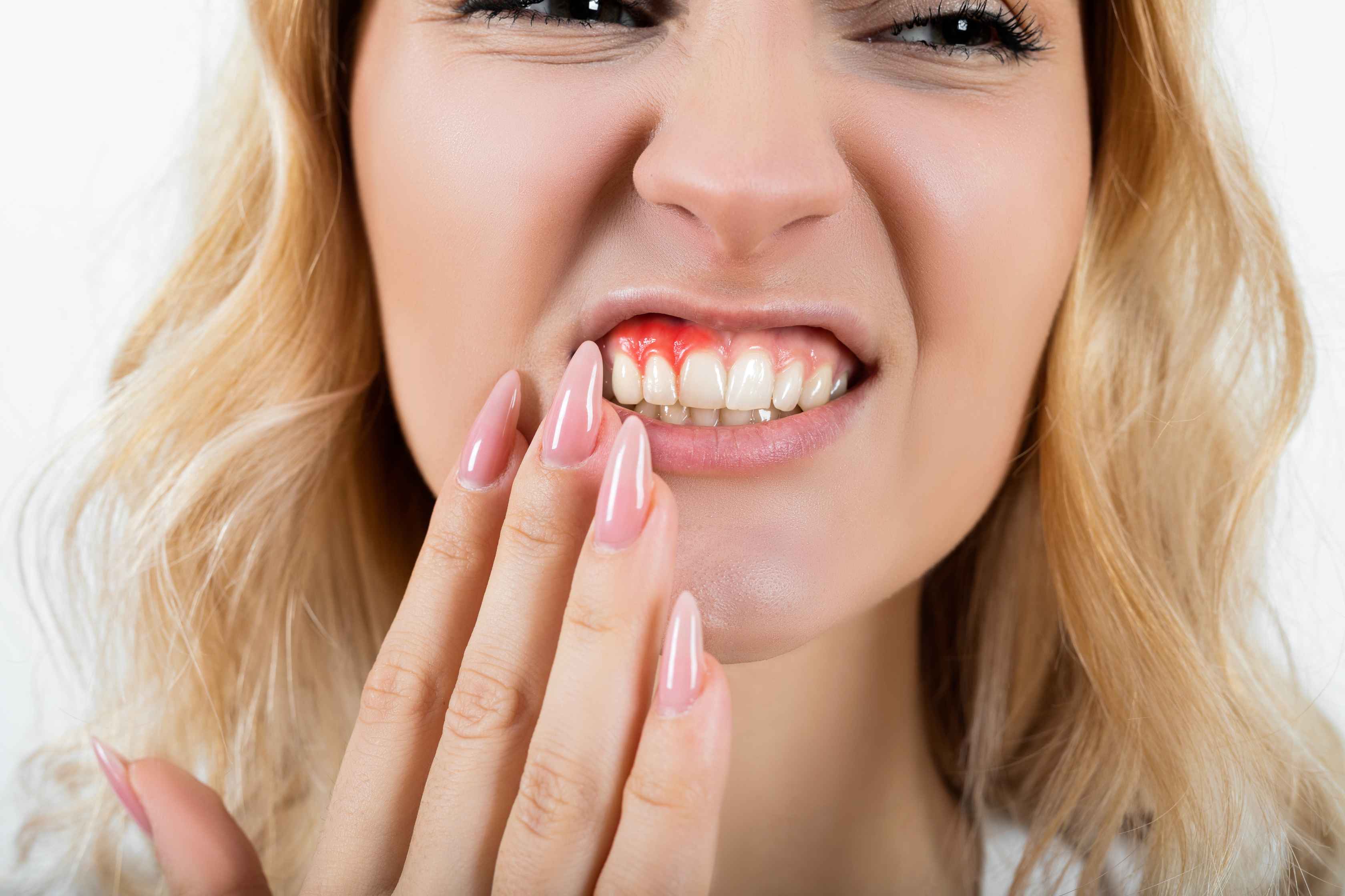 Close-up of a woman with blonde hair holding her cheek, showing inflamed and red gums indicating gum disease.