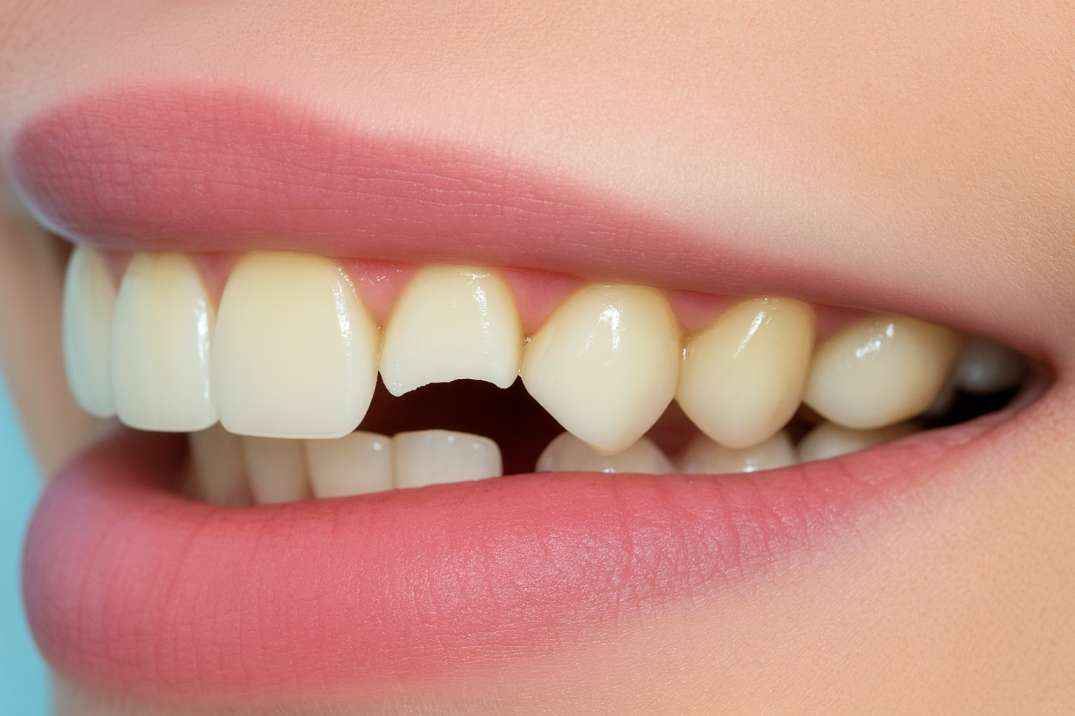 Close-up of a smiling mouth showing a chipped front tooth among natural teeth.