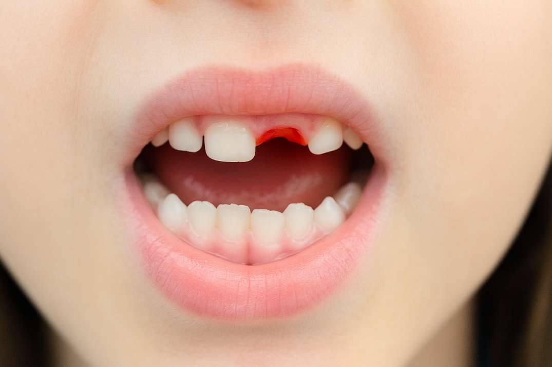 Close-up of a child's mouth with a missing upper front tooth and red gum at the gap.