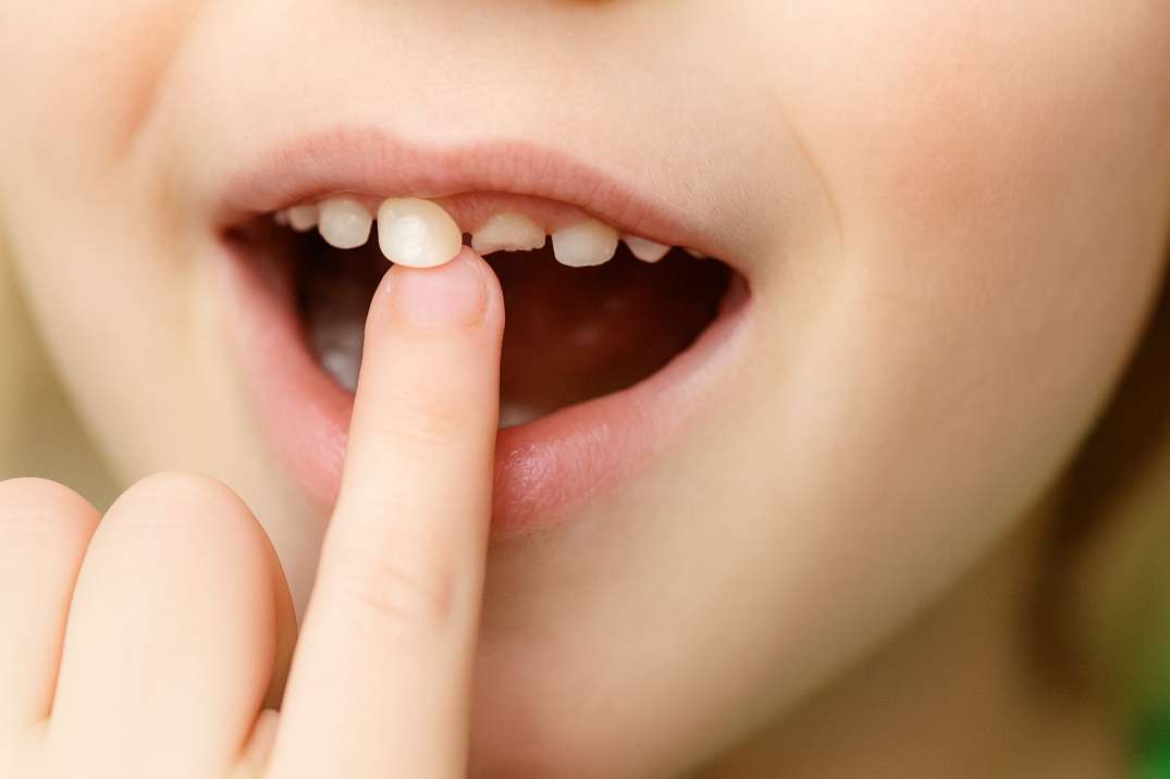 Close-up of a child’s mouth showing a finger touching a loose front baby tooth.