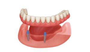 3D illustration of lower jaw with two dental implants supporting an overdenture.