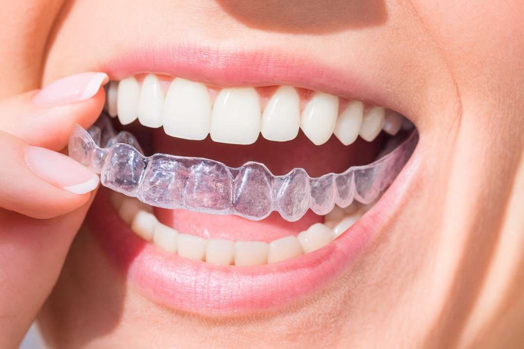 Close-up of a person inserting a clear dental aligner onto their upper teeth with a smile.