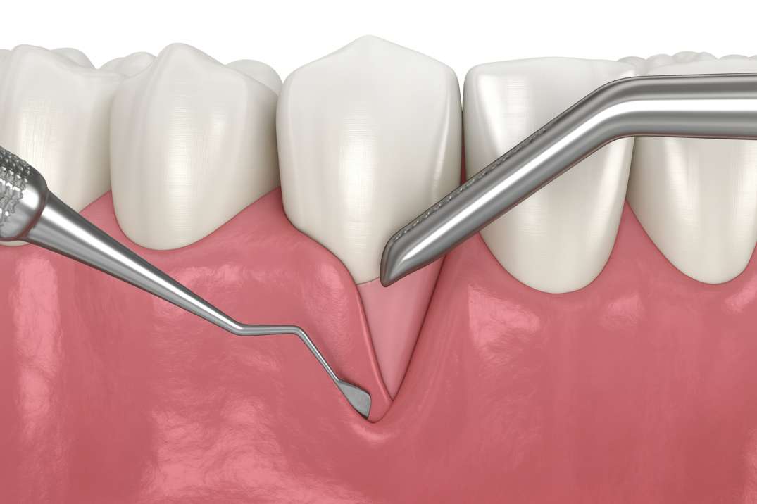 Illustration of dental tools examining receding gums and exposure of tooth roots between healthy teeth.