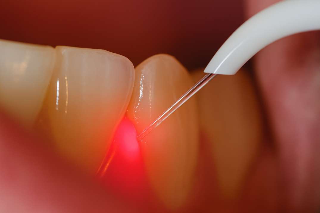 Close-up of dental laser treatment being applied near the base of a tooth.