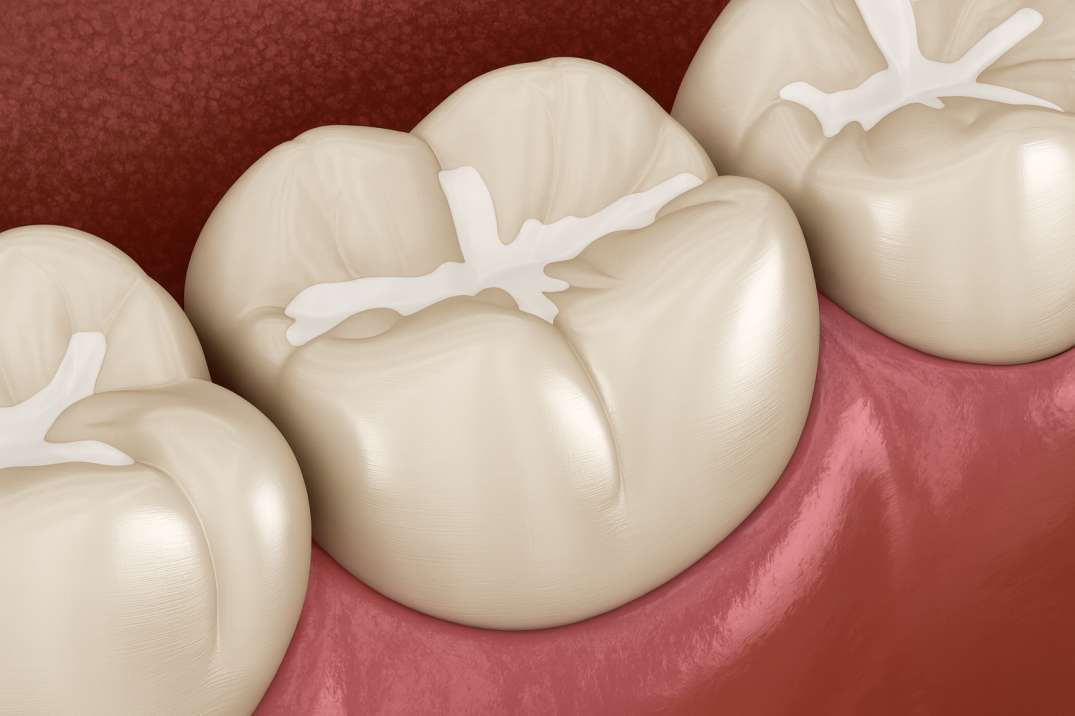 Close-up illustration of molar teeth with white dental sealants applied to the grooves and pits of the chewing surfaces.
