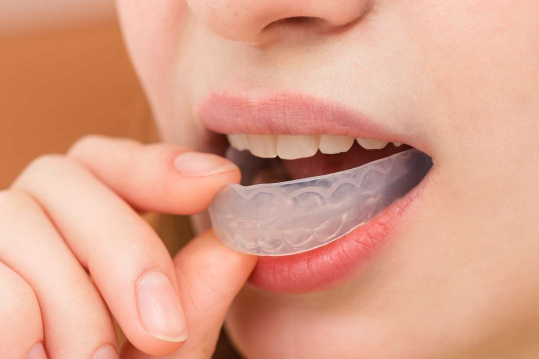 Close-up of a person inserting a clear dental night guard into their mouth.