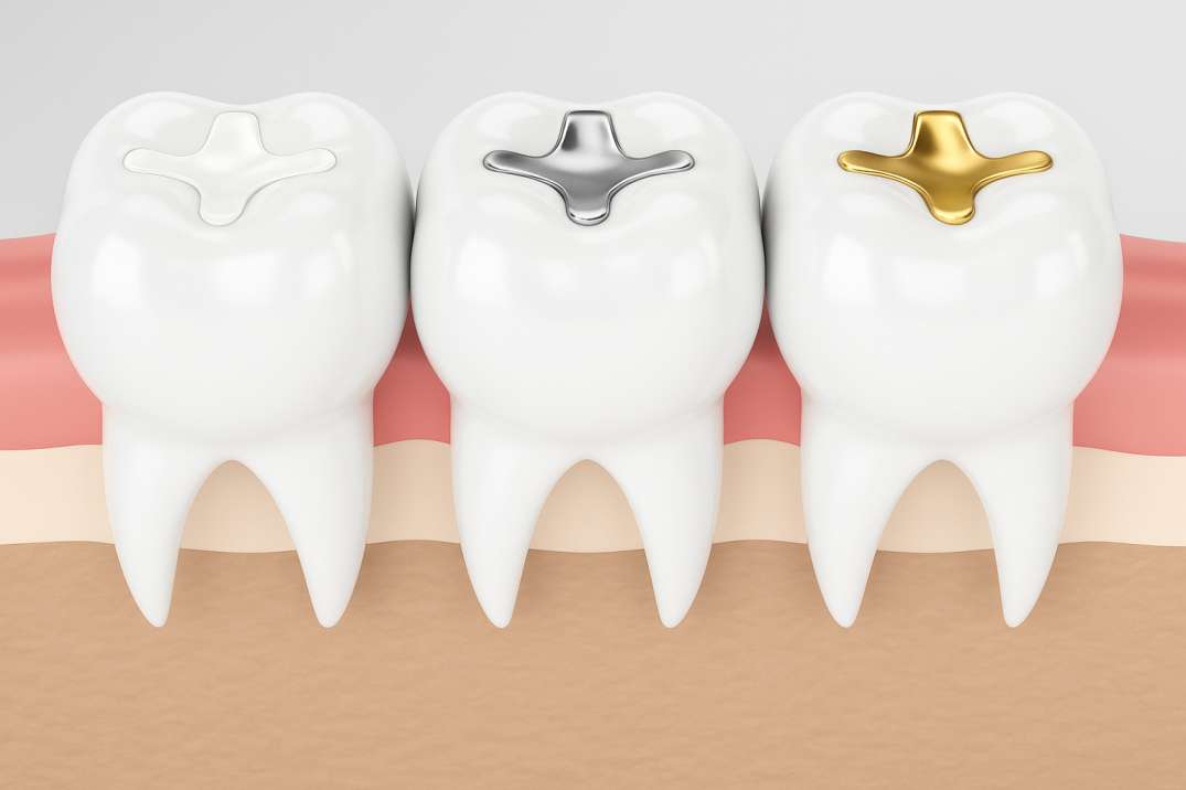 Three molar teeth with cross-shaped dental fillings in white, silver, and gold, shown embedded in gums.