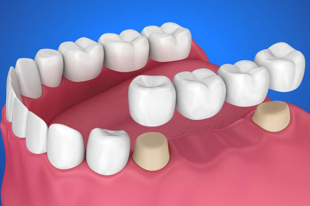 3D illustration of dental bridge placement showing two natural teeth with crowns and three prosthetic teeth between them replacing missing teeth on lower jaw.