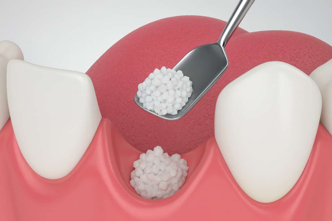Dental illustration showing bone grafting material placed into a tooth socket between two teeth.