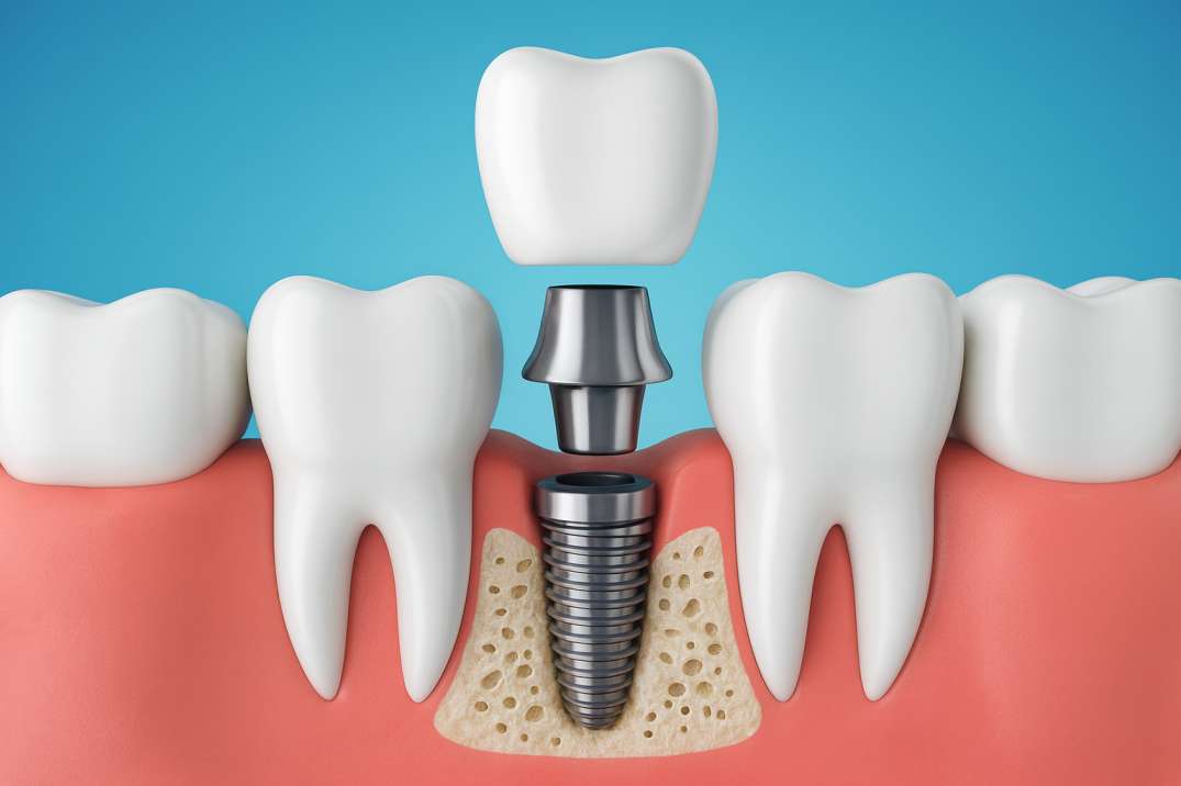 3D illustration of a dental implant showing the metal screw embedded in jawbone with an abutment and crown above it, surrounded by natural teeth and gums.