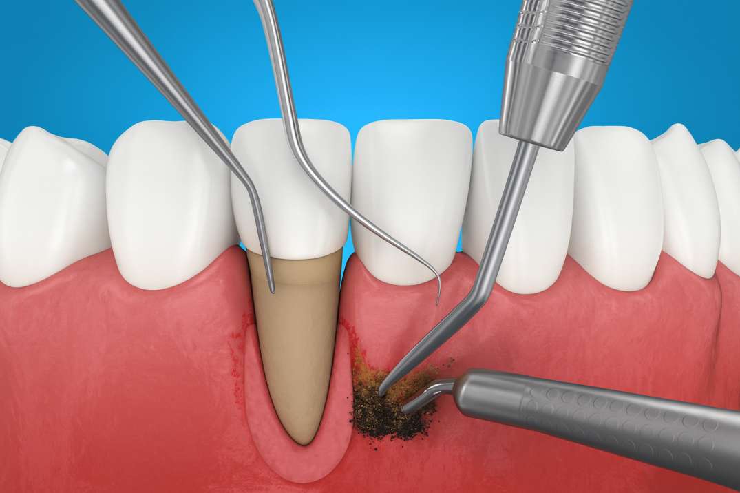 Dental illustration showing periodontal instruments cleaning tartar from a tooth root beneath the gum line in pocket reduction surgery.