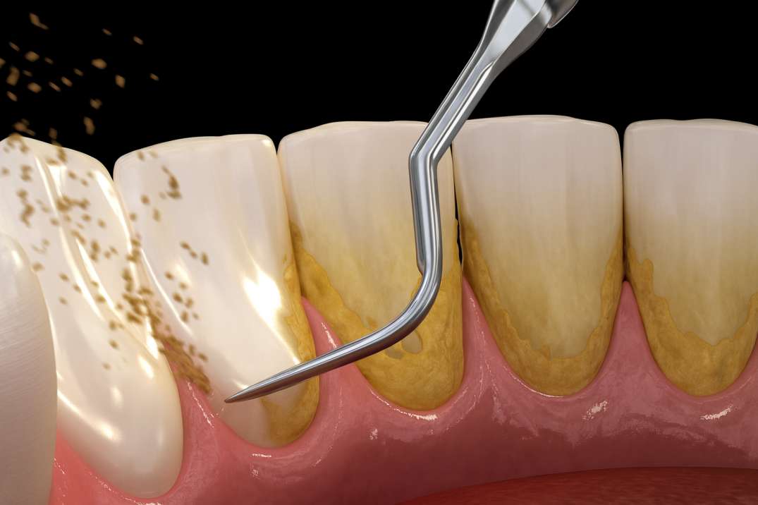 Dental scaler tool removing yellow tartar buildup from teeth near the gums.