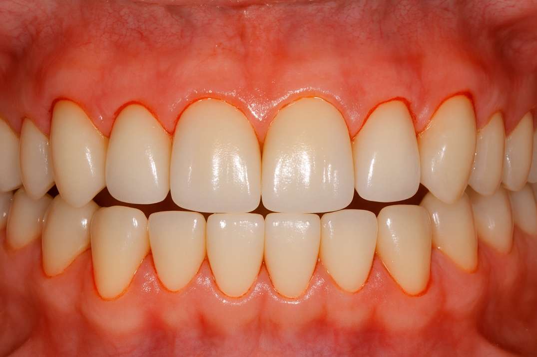Close-up of upper and lower front teeth and gums with visible inflammation around the gum line.