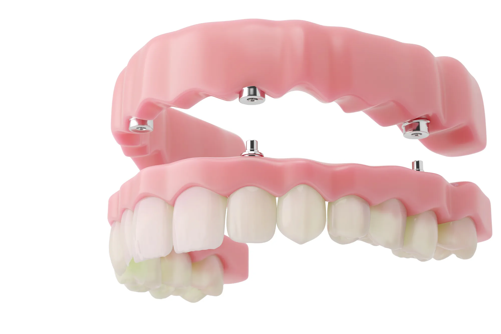 Full-arch All-on-4 dental implant bridge supported by implants