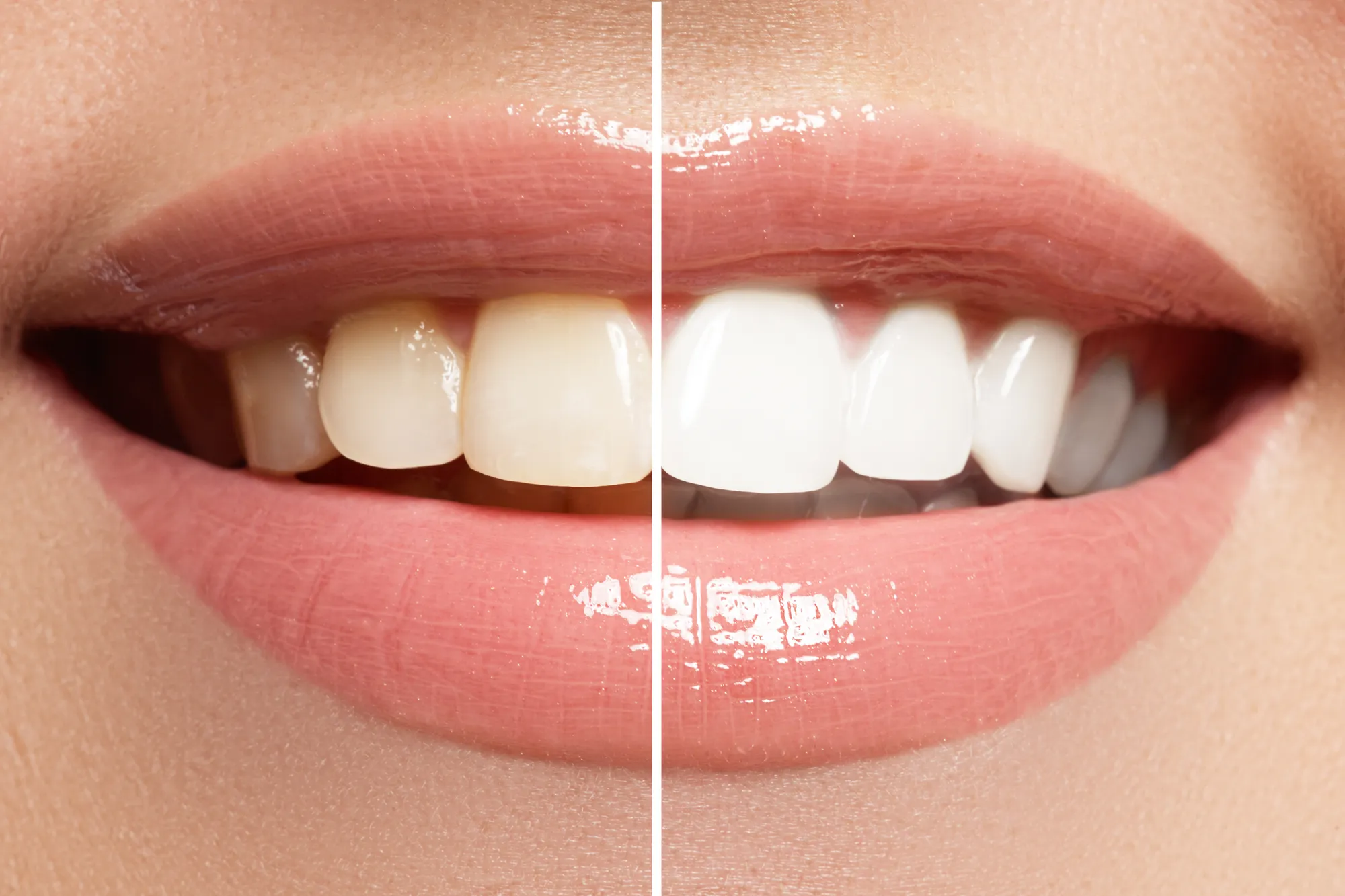 Before and after comparison of a smile with cosmetic dental treatment
