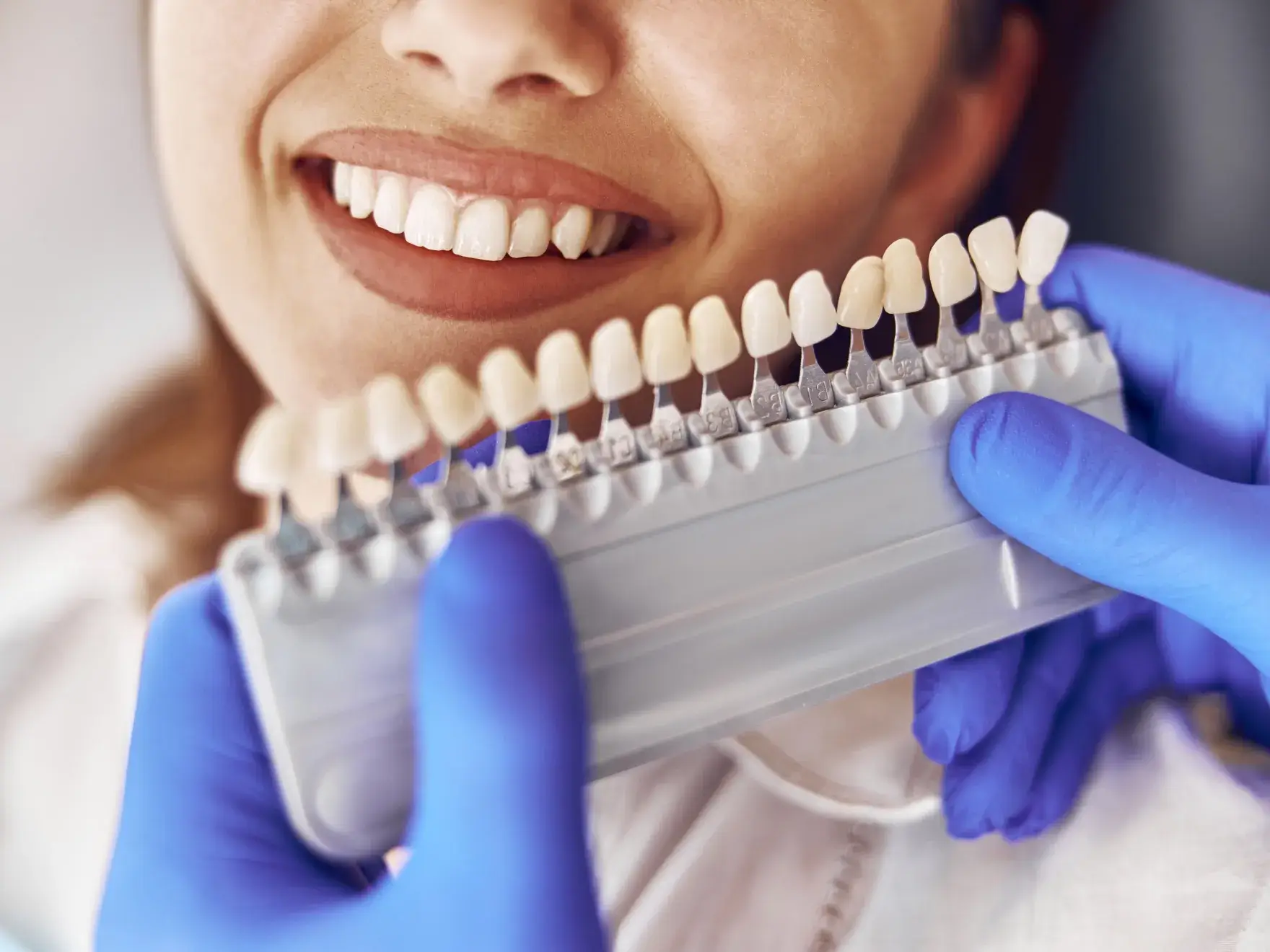 Close-up of a smiling person showing teeth while a dental professional in blue gloves holds a shade guide against their teeth for color matching.