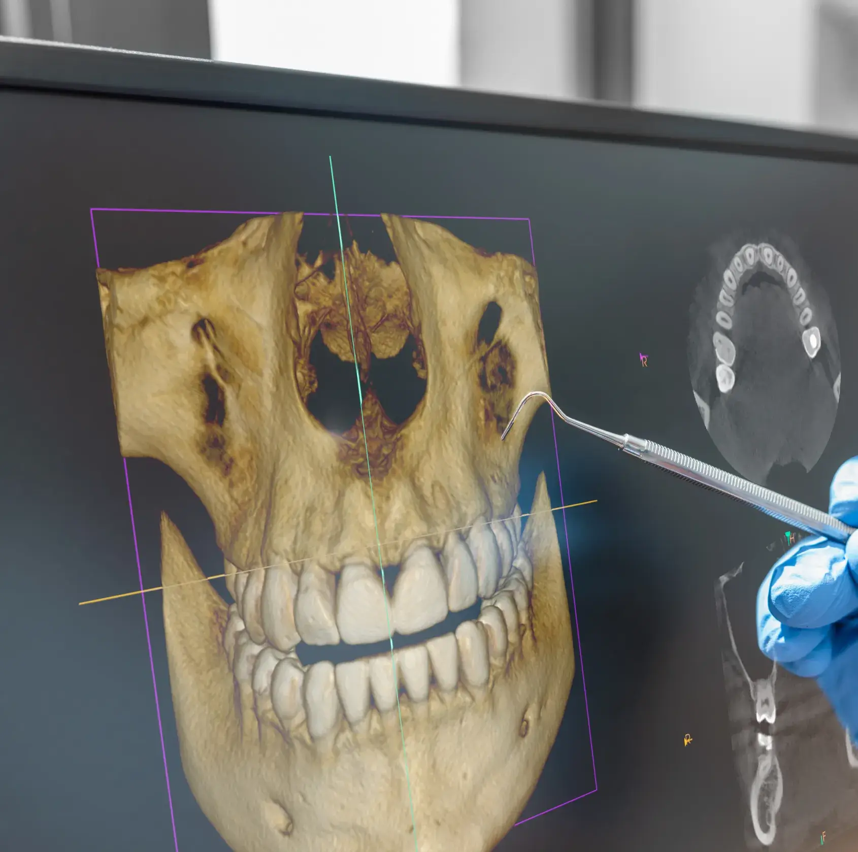 3D dental scan image on a screen showing a skull and teeth with a dental tool pointing at it.