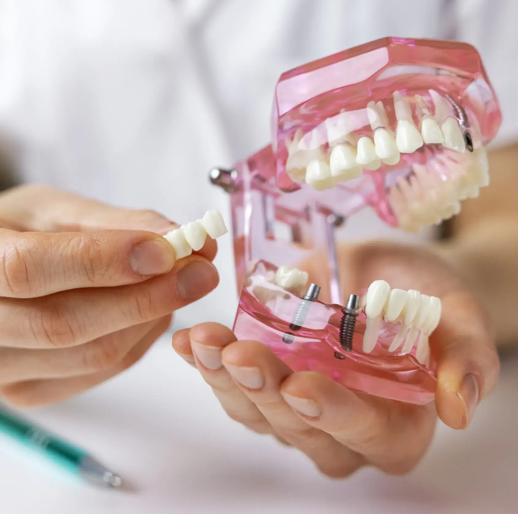 Hands holding a dental model with artificial teeth and implants, demonstrating a dental bridge replacement.
