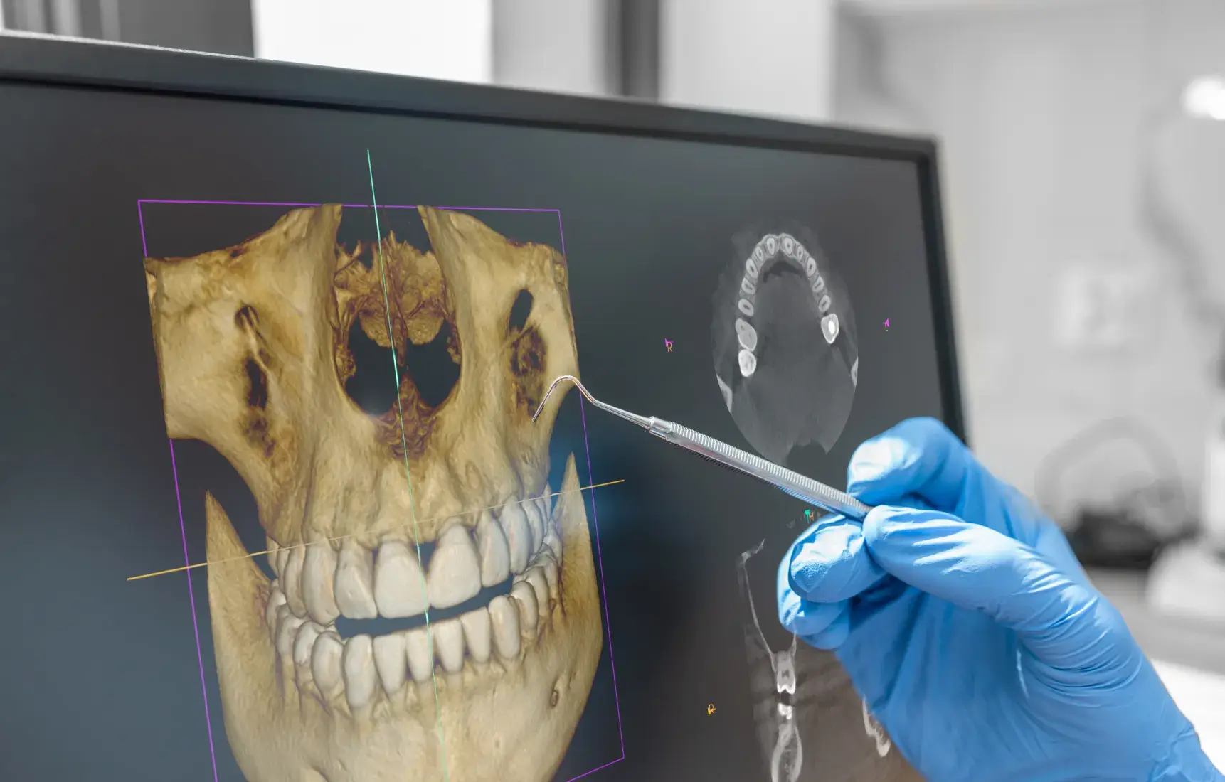 Hand in blue glove holding a dental explorer pointing at a 3D digital skull and dental X-ray images on a computer screen.