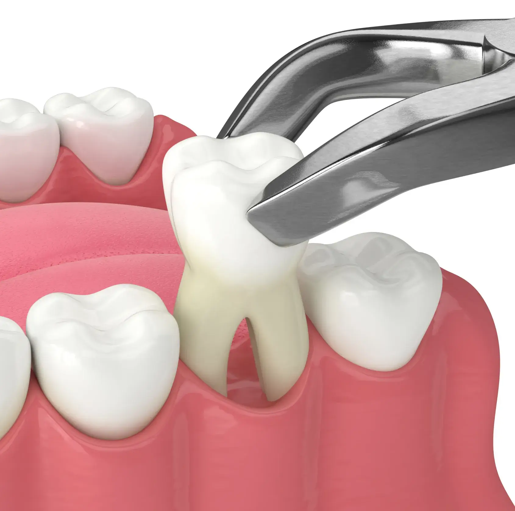 Dental forceps extracting a molar tooth from pink gums surrounded by adjacent white teeth.