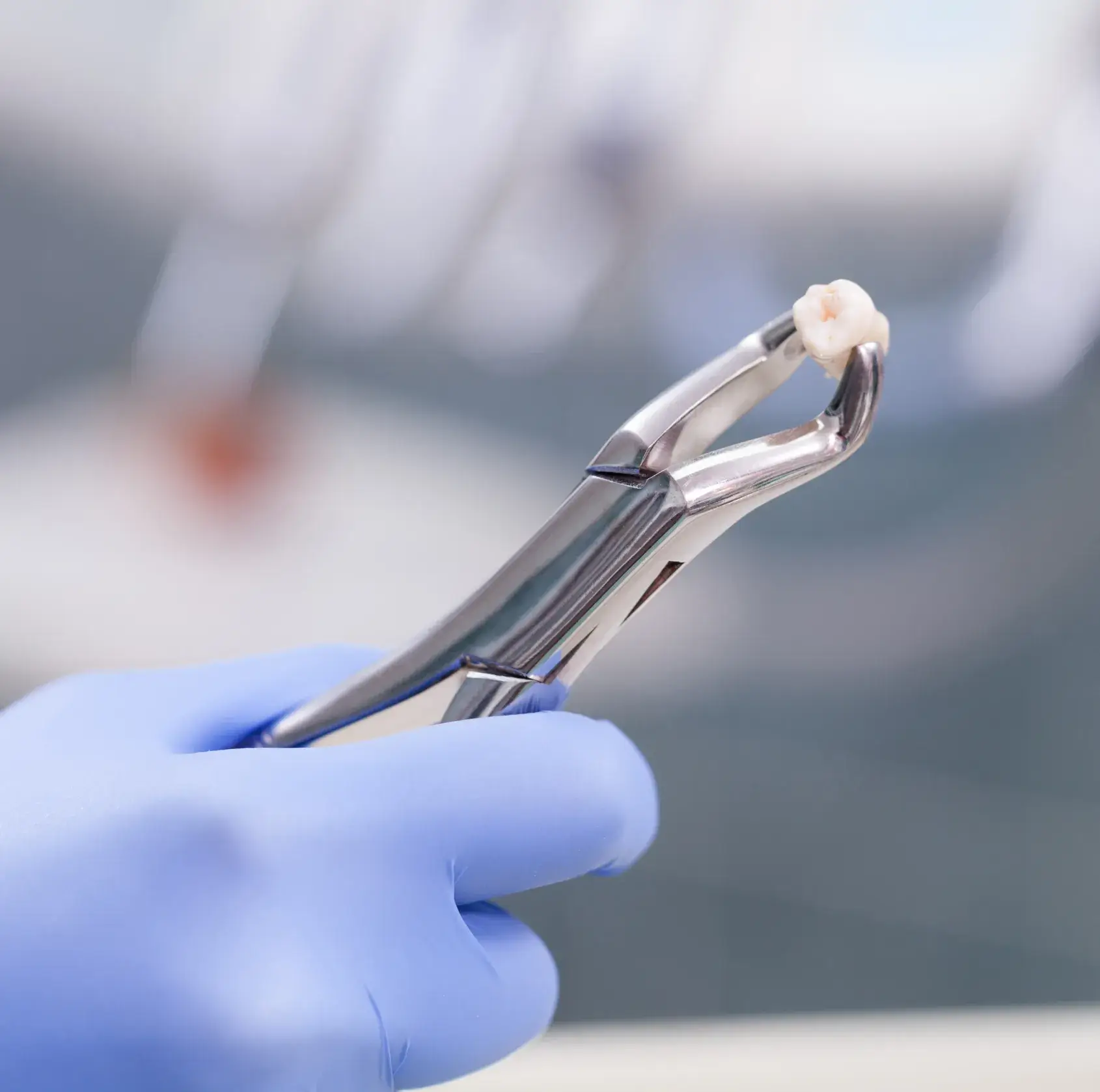 Gloved hand holding dental extraction forceps gripping a tooth.