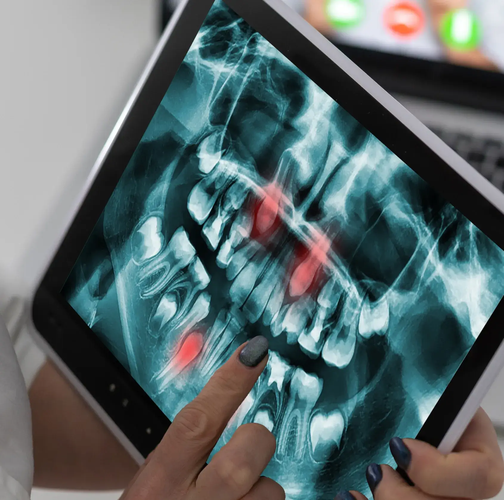 Dental X-ray on a tablet with four teeth highlighted in red, a person pointing at one of them.
