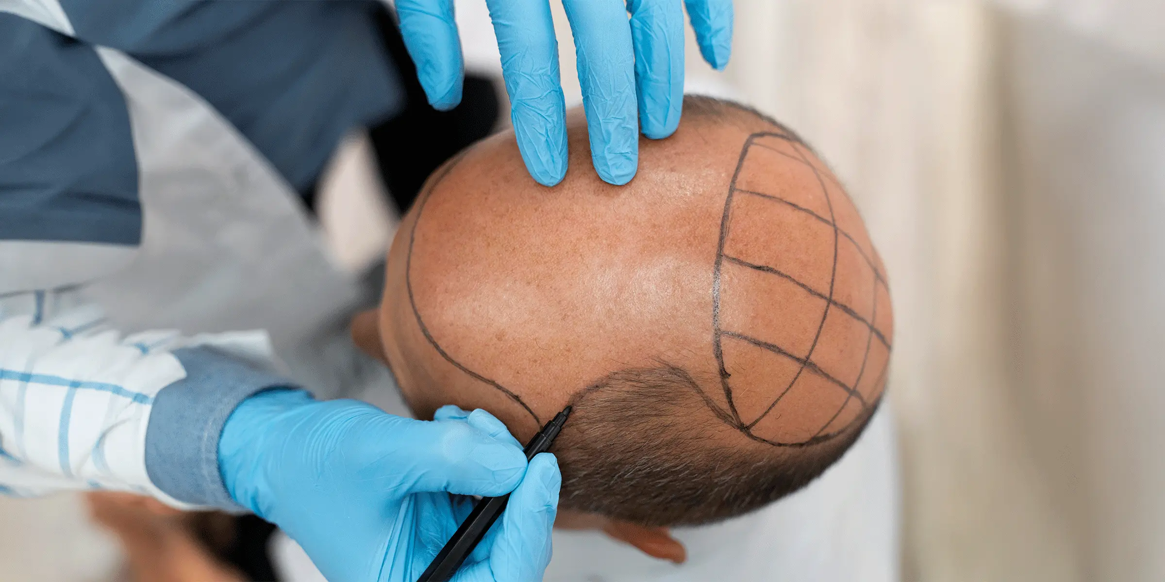 hair transplant procedure turkey clinic