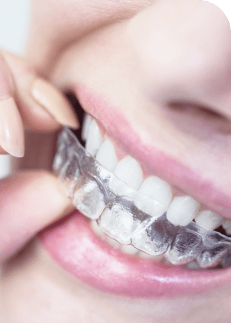 Close-up of a person placing a clear dental aligner over their teeth.