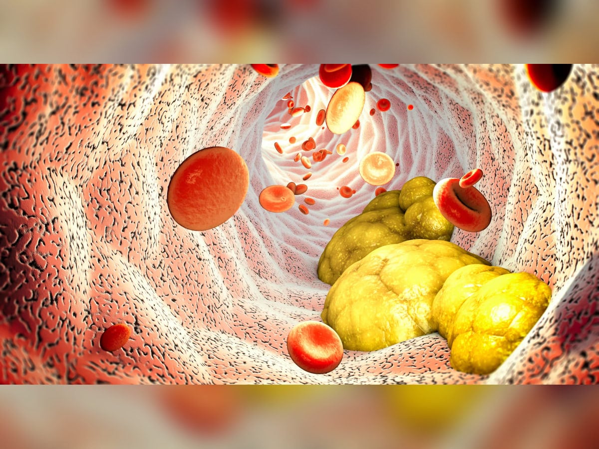 Was senkt Lipide besser – Ernährung oder Tabletten?
