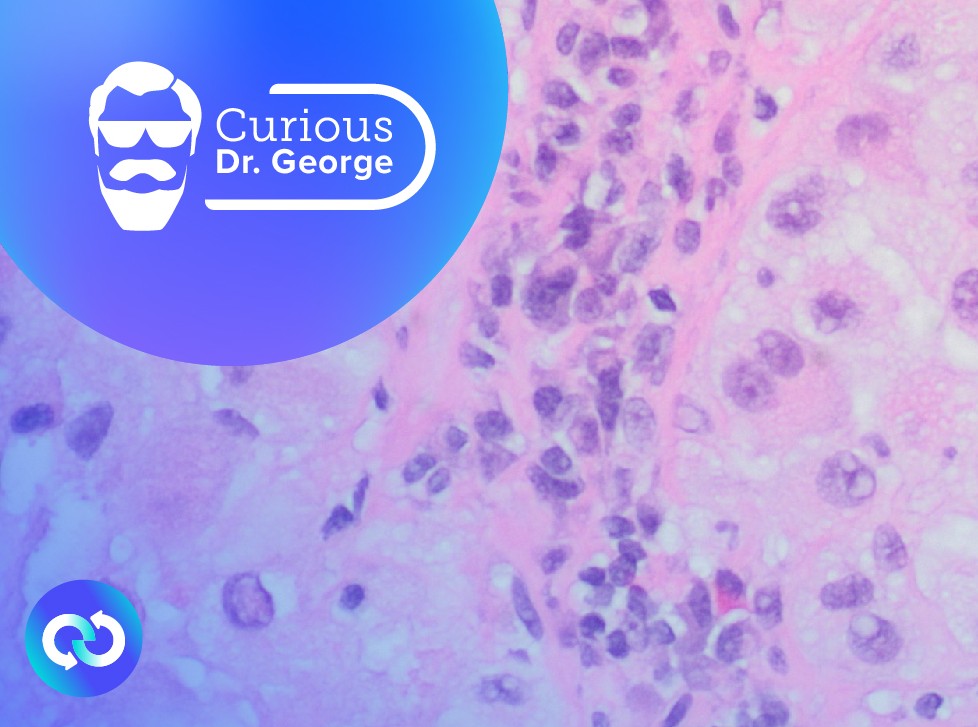 How an Expert Would Treat Her Own Metastatic Melanoma: an Update