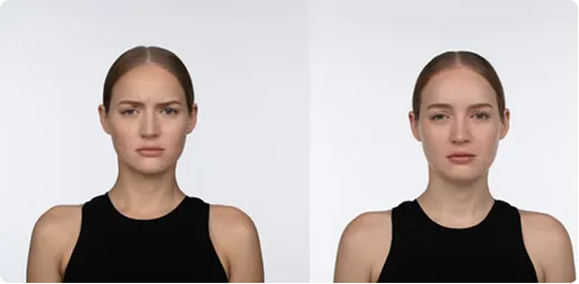 Before and after Jeuveau neuromodulator results at AlyneMD, softened forehead lines