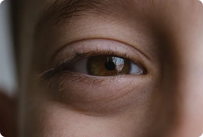 Non-Surgical Treatment for Hooded & Droopy Eyelids