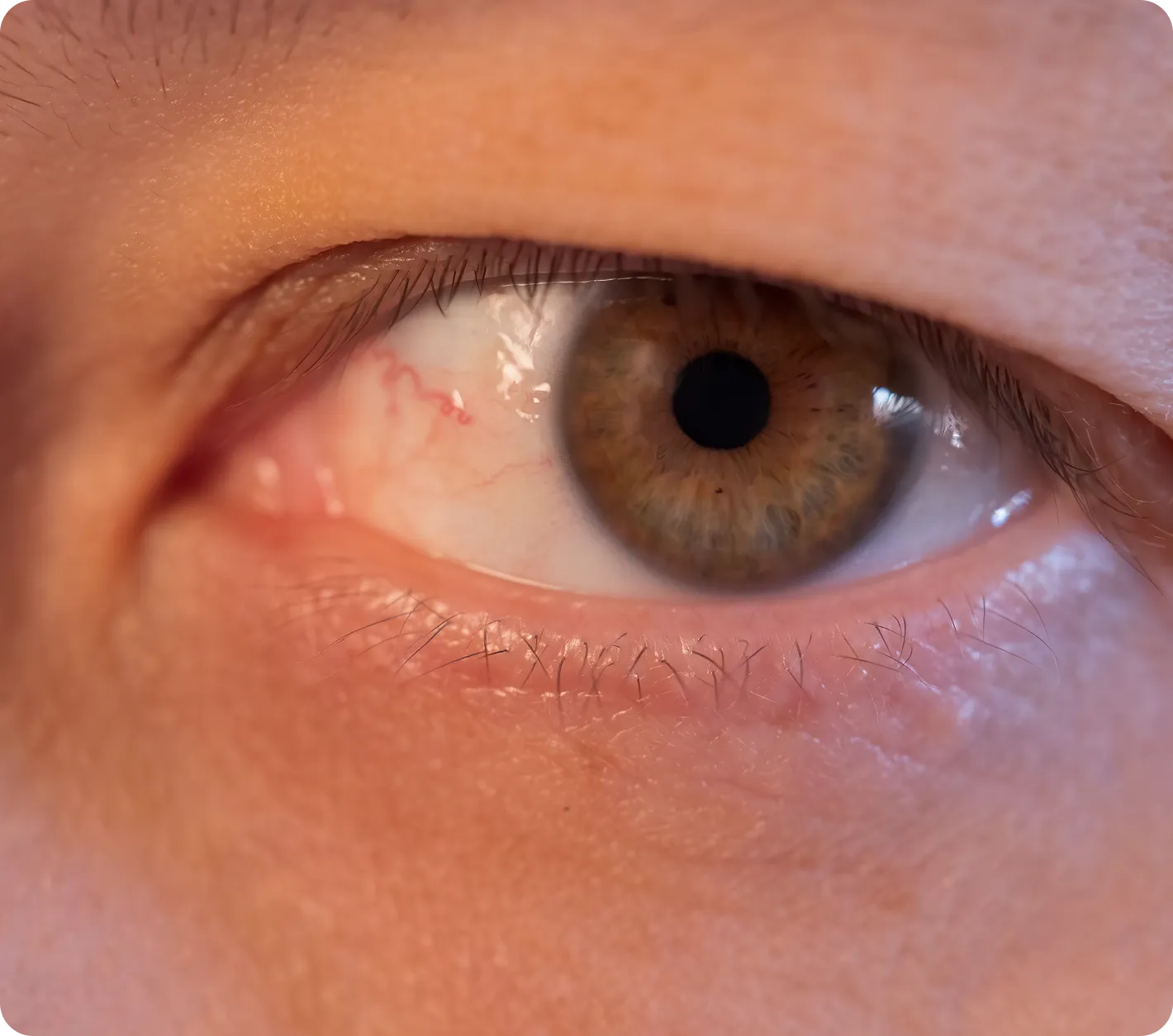 Non-Surgical Treatment for Hooded & Droopy Eyelids