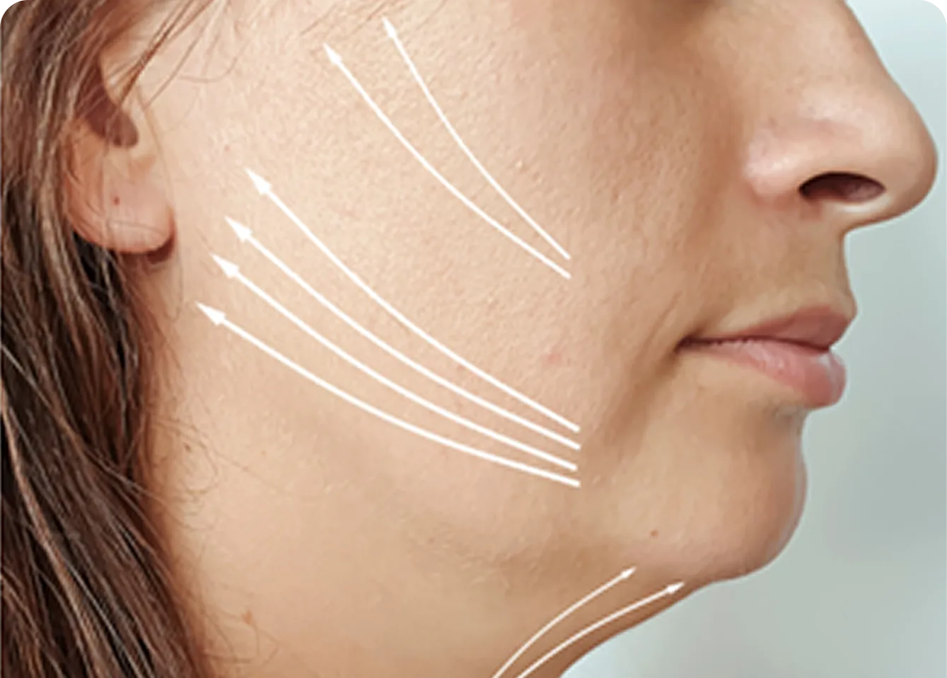 Stubborn Fine Wrinkles treatment