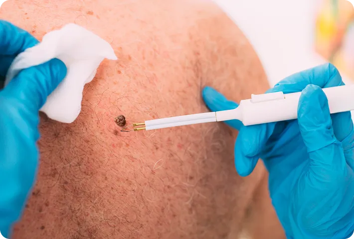 Benign Lesions & Tags