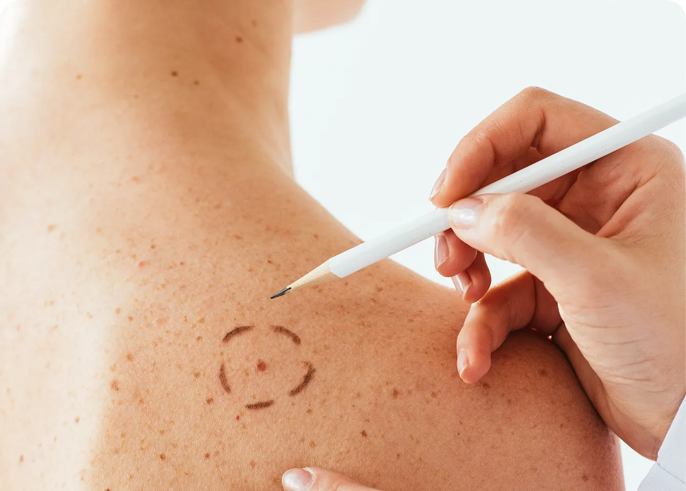 Benign Lesions & Tags
