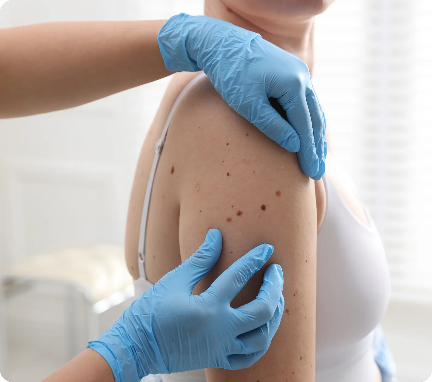 Benign Lesions & Tags