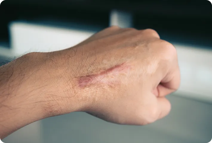 Surgical Scars