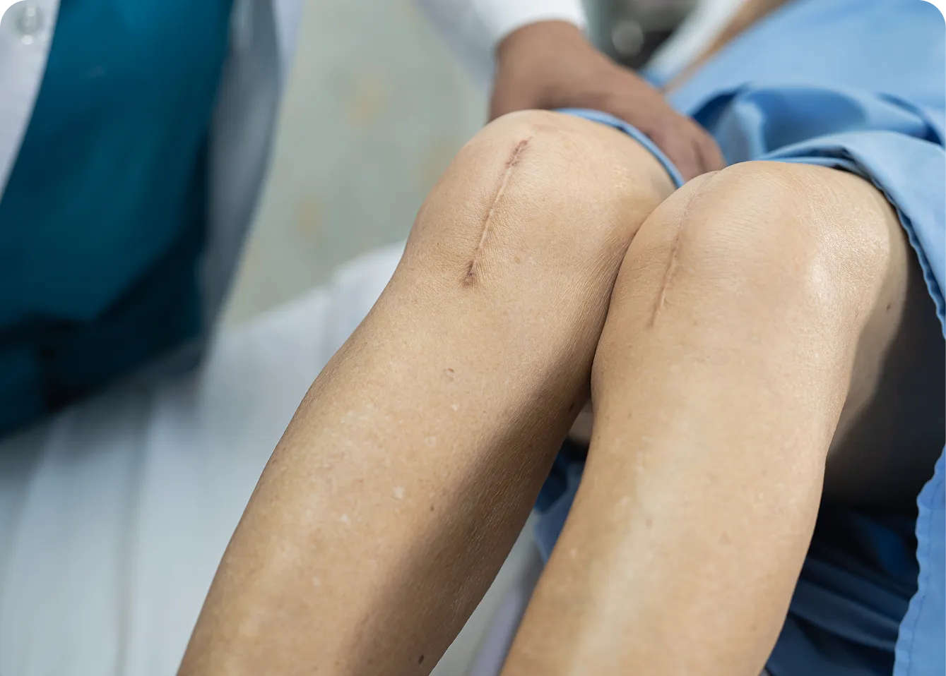 Surgical scar treatment at AlyneMD