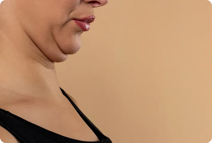 Double Chin