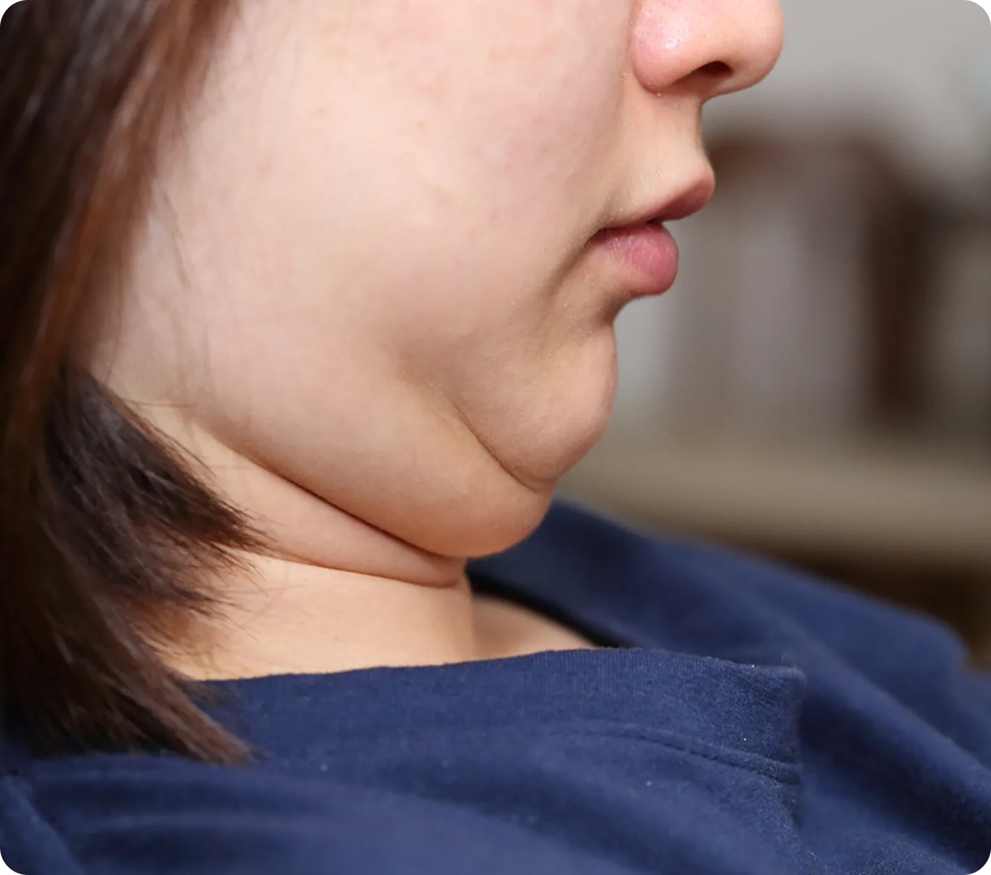 Double Chin