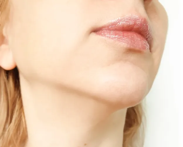 Dermal filler treatment detail