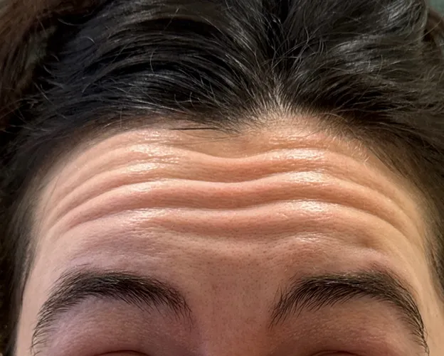 Before and after Botox forehead treatment at AlyneMD — before photo
