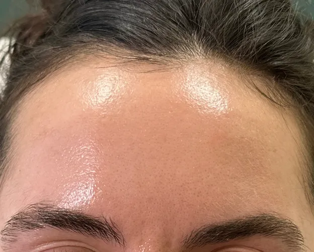 Before and after Botox forehead treatment at AlyneMD — after photo